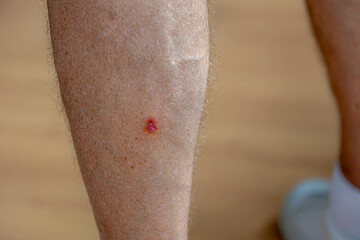 Healthcare and medical concept, Selective focus of red spot on the right side of calves, Blister on...