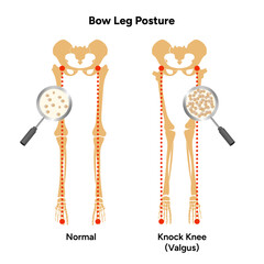 Leg bones position Blowlegged knock kneed face curvature