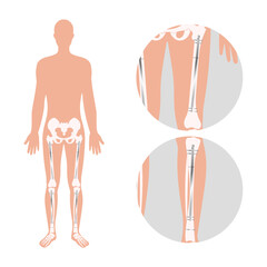 internal nail in an adult femur