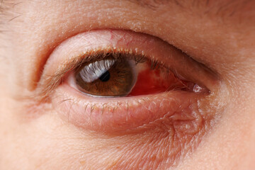 Obraz premium Gros plan d'un oeil avec une hémorragie sous conjonctivale