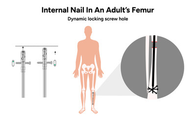 internal nail in an adult femur