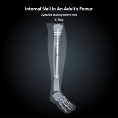 internal nail in an adult femur x-ray