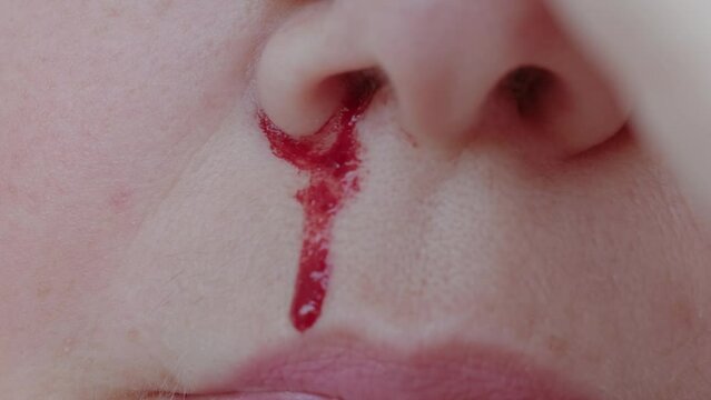 bright red blood flows from nostril, bright red blood flows from nostril, close-up part of face, fragility of blood vessels, heart diseases, sharp increase in blood pressure