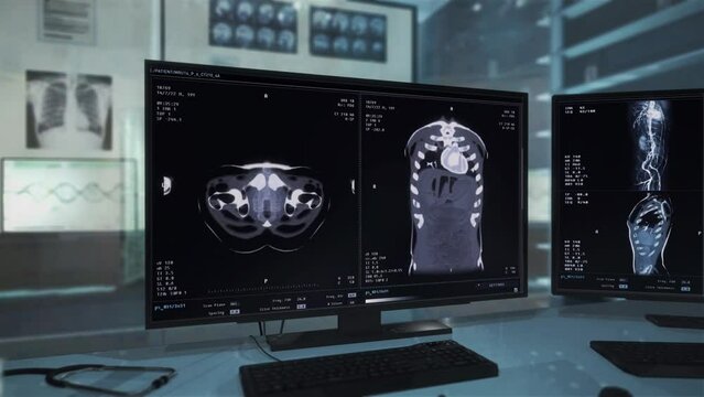 Radiology image analysis of the ill persons chest at the hospital ward. Radiology image analysis system examining the body. Radiology image analysis technology scanning the patient. X-ray.
