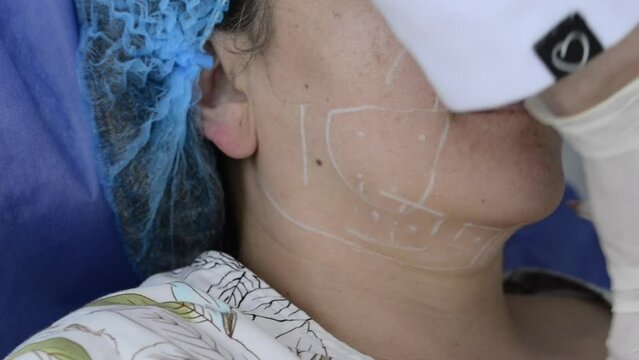 Doctor making marks on patients face for aesthetic procedure. Plastic surgery preparation