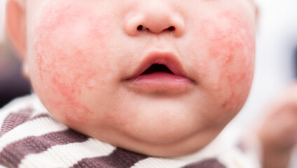 Red rash with Itching due dust or allergy on baby face, fungus, allergy, dermatological disease,...