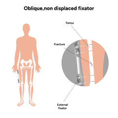 Oblique nondisplaced fixator
