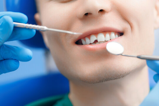 Closeup man smile mouth with broken tooth at reception at dentist, concept of healthy smile