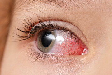 Closeup irritated infected red bloodshot eyes, conjunctivitis