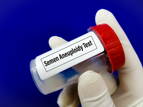 Doctor holding tube with semen sample for Semen Aneuploidy screening test