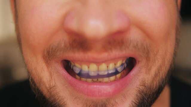 Man puts on mouth guard close-up. Dental orthodontic trainer for adult person.