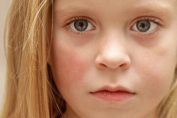 Redness on child's cheeks caused by eczema, dry skin or allergy 