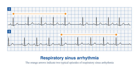 Respiratory sinus arrhythmia is diagnosed when the heart rate increases during inspiration and slows down during expiration, and the difference between the P-P interval exceeds 120 or 160 ms.