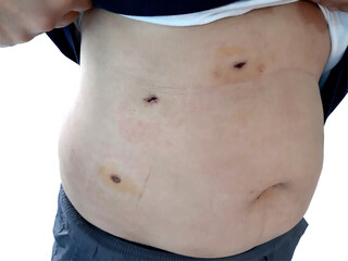 scars from gallbladder surgery