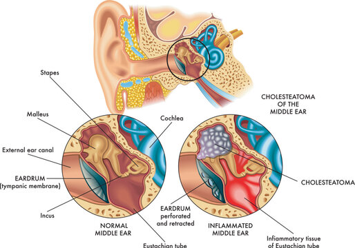 Medical illustration comparing the internal part of the ear (middle ear) on the left healthy and on the right affected by cholesteatoma, with annotations.