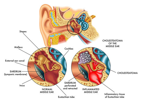 Medical illustration comparing the internal part of the ear (middle ear) on the left healthy and on the right affected by cholesteatoma, with annotations.