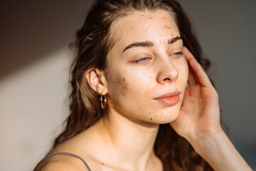 Young woman touching a pimple on her face, feeling annoyed because of problems with skin....