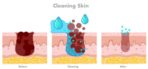 Skin cleaning, facial skin care, pore cleaning stages clogged facial. absorb, rejuvenation wrinkles. Human facial fillers. Water moisturizer. Dermatology, skincare, anti aging. Vector illustration