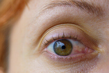 Caucasian Woman's Eye with Symptoms Similar to Pinguecula, Scleritis, Ocular Surface Squamous...