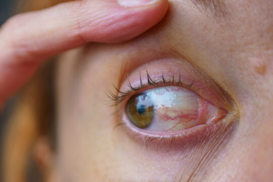 Caucasian Woman's Eye with Symptoms Similar to Pinguecula, Scleritis, Ocular Surface Squamous Neoplasia (OSSN)