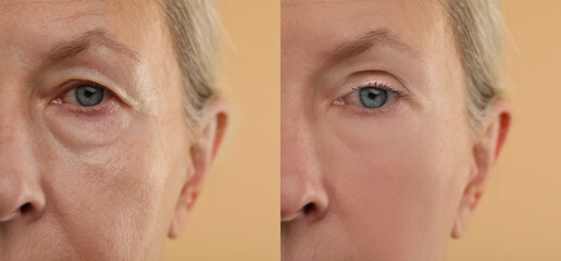 Aging skin changes. Woman showing face before and after rejuvenation, closeup. Collage comparing...