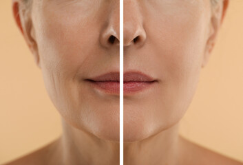 Aging skin changes. Woman showing neck before and after rejuvenation, closeup. Collage comparing...