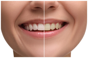 Woman showing teeth before and after whitening on white background, collage