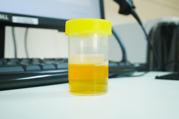 Urine analysis in laboratory.
