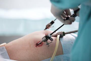 Laparoscopy in surgery. Surgery in the abdominal cavity through small holes. Surgical team....