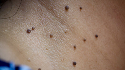 High-resolution close-up image showcasing skin tags, also known as acrochordon, on the neck of a...