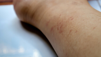 Close-up of skin rash on a woman's foot. ideal for medical, dermatological, healthcare, and skincare concepts. Allergy, allergic reaction from atopiy, insect bites on her arm, itchy red spot
