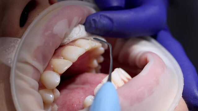 Process of teeth cleaning or treatment with dental clinic close-up. Installation of veneers or teeth cleaning in modern dentistry.