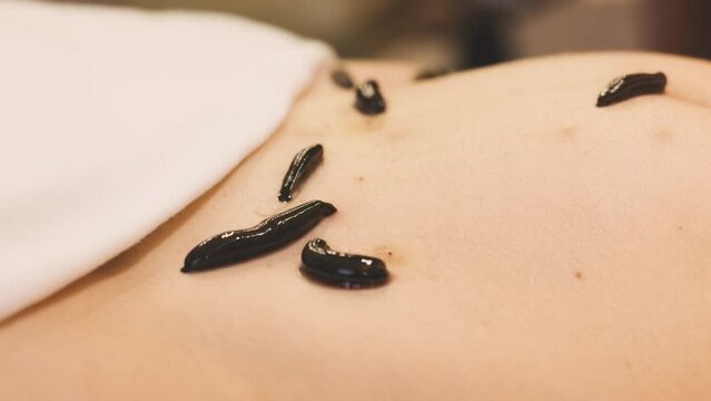 Close-up shot of medical leech on human body skin drinking blood, traditional medicine, hirudotherapy. Treatment with leeches and bloodletting. Freshwater worm. alternative treatment health concept 4k
