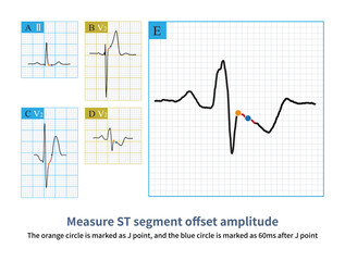 Firstly, select point J as the reference point, and then select 60ms after point J as the measurement point to evaluate the ST segment offset morphology and amplitude.