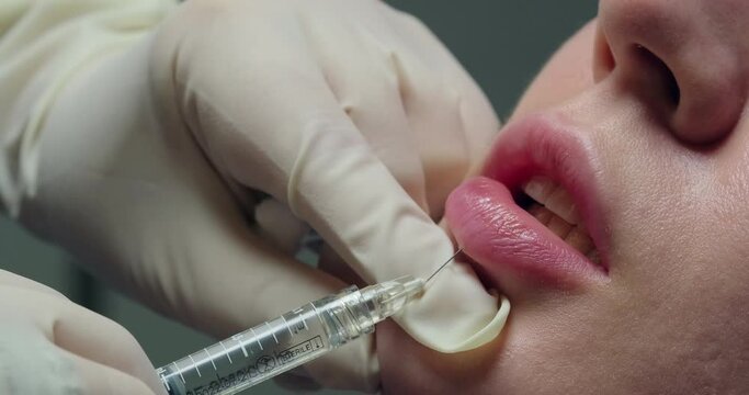 Doctor cosmetologist injects hyaluronic acid filler into woman's lips. Lip augmentation injection. Close-up