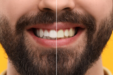 Man showing teeth before and after whitening on orange background, collage