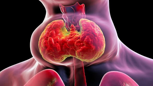 Enlarged thyroid gland, or thyroid goiter. Thyrotoxicosis, 3D animation.