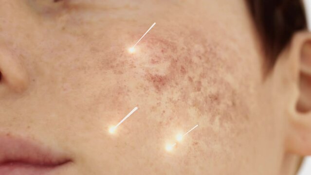 Laser treatment for skin problems. Laser removes freckles and repairs the skin.