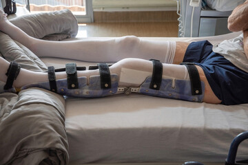 a man with a broken leg in an orthosis on a bed in a clinic after an accident and a fracture of the...