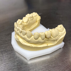 photo of the lower jaw, a plaster impression of the jaw on a metallic background, a model of teeth, dental technique