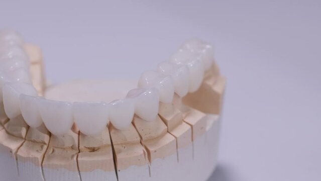 Artificial jaw mold with dental crowns, rotating on white background. Dental prosthesis, artificial tooth, prosthetic. Dental implants, Modern dentist technology.