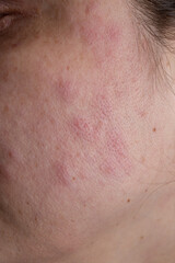 Fototapeta premium Red rash eczema on a woman face due to fat liver disease , close up texture