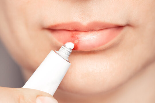 Herpes on the lips of the young woman . Woman lubricates the labial herpes ointment