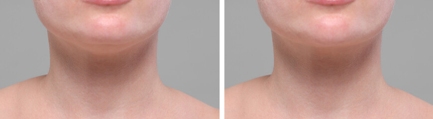 Aging skin changes. Woman showing neck before and after rejuvenation, closeup. Collage comparing skin condition
