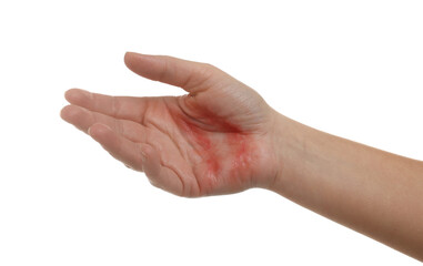 Woman with burned hand on white background, closeup