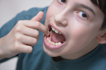 A boy's tooth falls out of his mouth in close-up