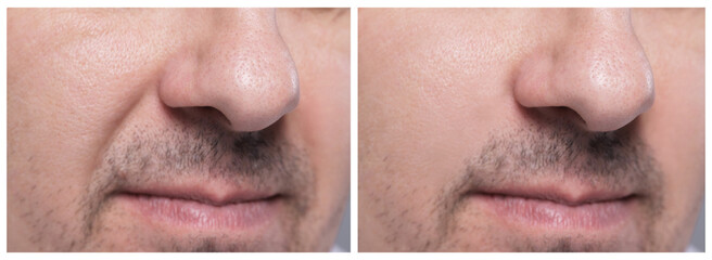 Aging skin changes. Man showing face before and after rejuvenation, closeup. Collage comparing skin...