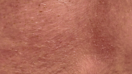 Fototapeta premium Close-up texture of human skin showing hair and sun allergy bubbles, suitable for health and dermatological concepts