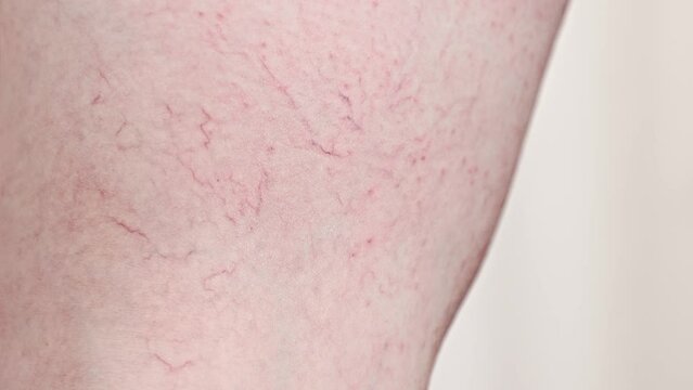 Close-up of woman's leg with red rash and vascular asterisks. Concept of varicosity and skin problem