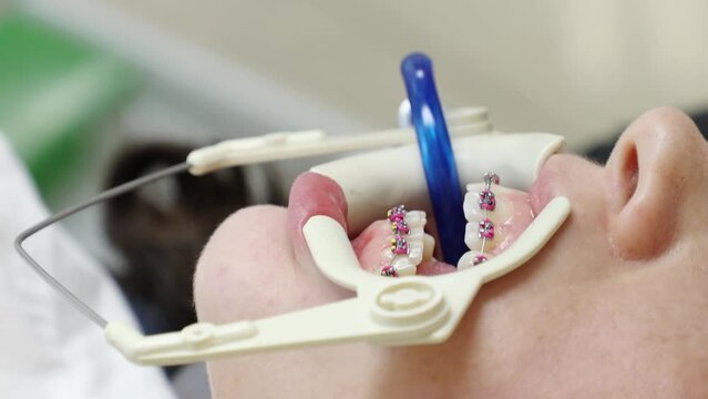 Orthodontist installs ligature bracket system on woman's teeth. Close-up. Concept of orthodontic treatment and alignment of dentition
